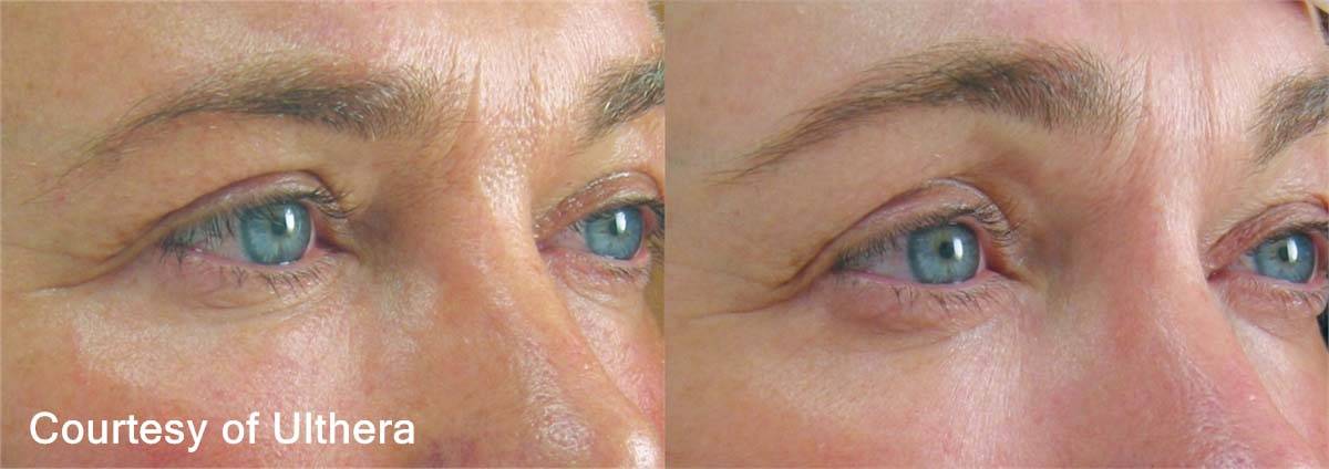 Ultherapy Before and After 2