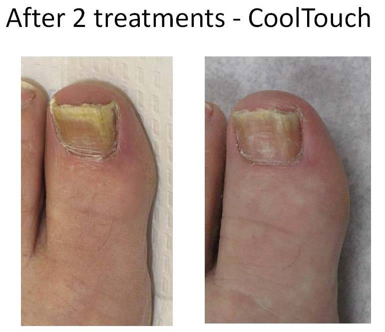 CoolTouch Before and After 3