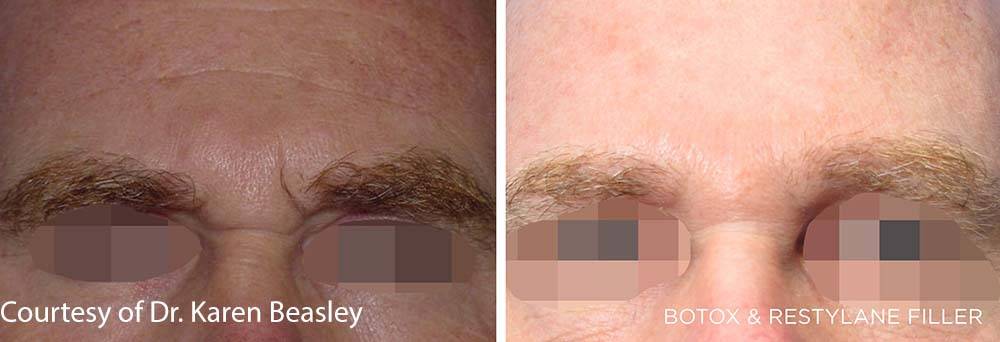 Restylane Lift Before and After Image 5