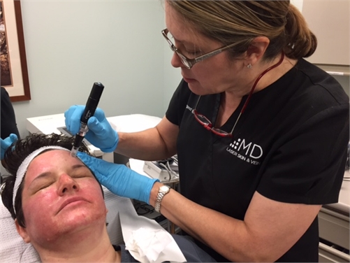Microneedling forehead lines treatment