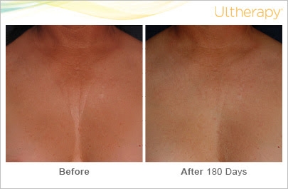 Ultherapy Décolletage image
