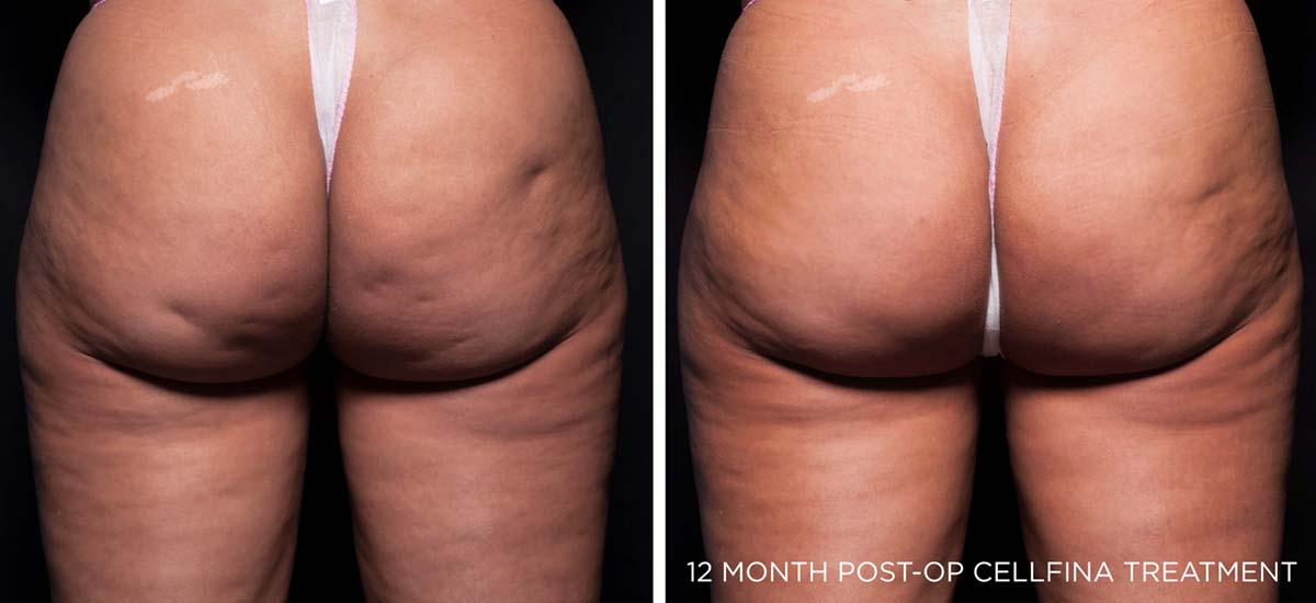Before and After Cellulite Treatment 2