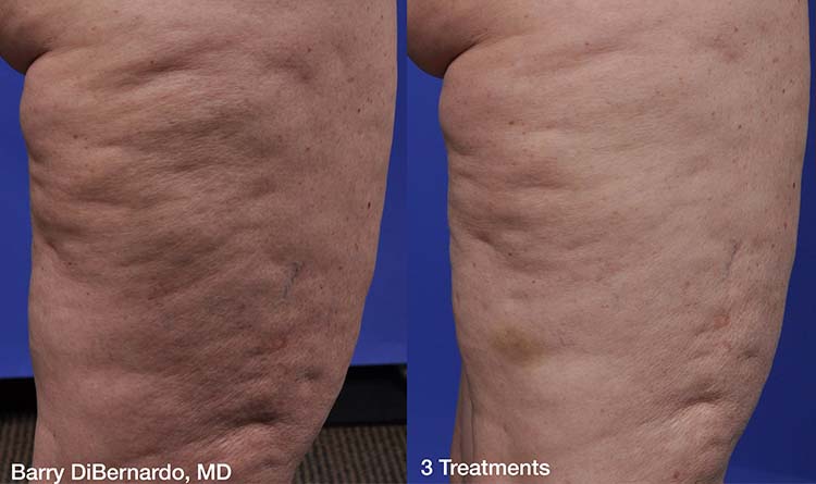 Before and After Cellulite Treatment 3