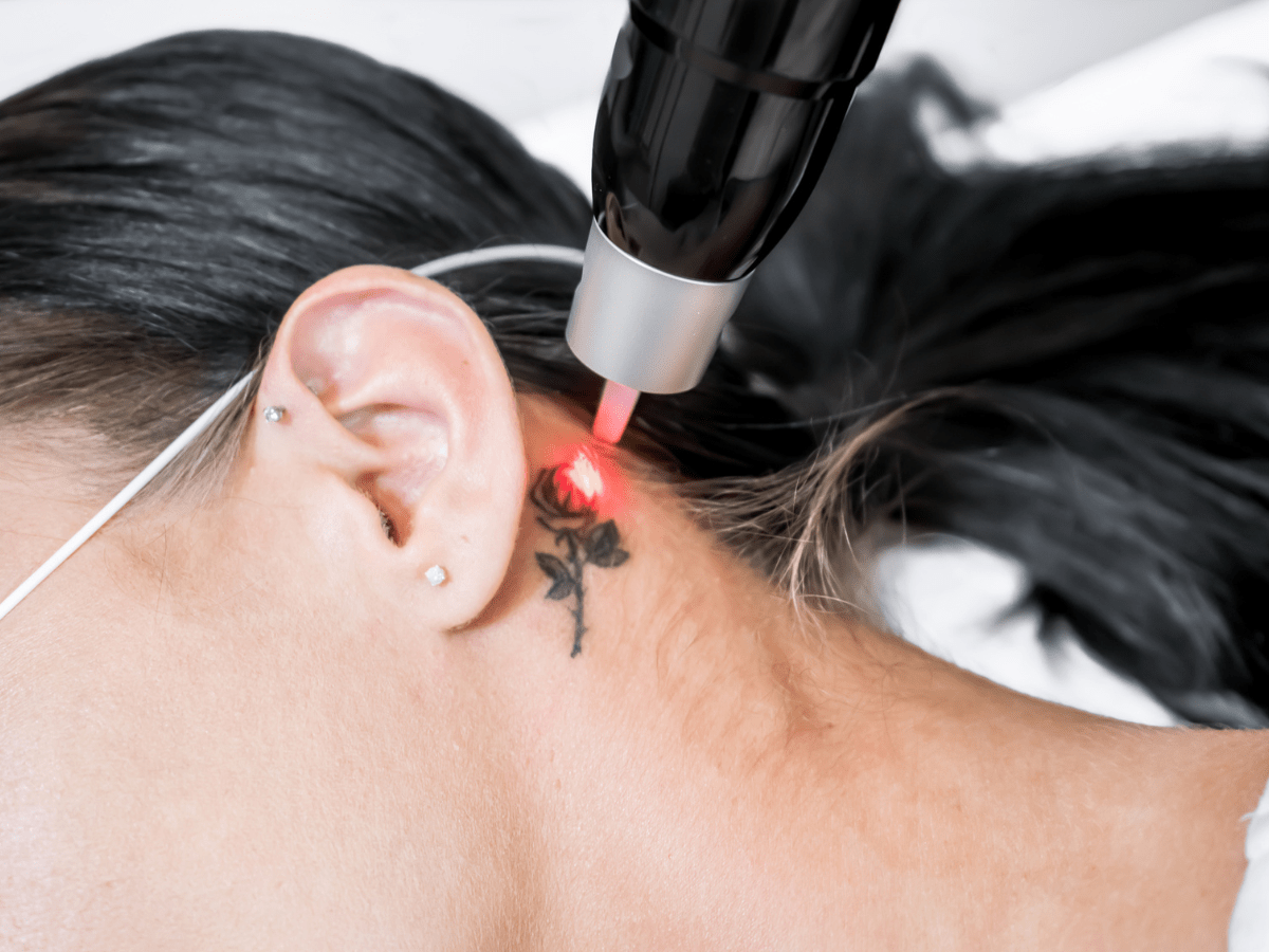 woman getting laser treatment