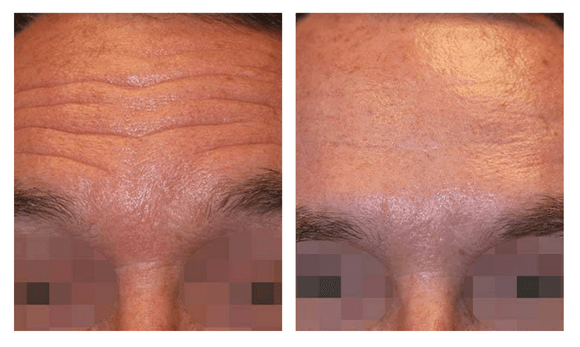forehead botox before and after