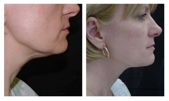 double chin botox before and after