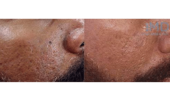 CoolTouch before and after