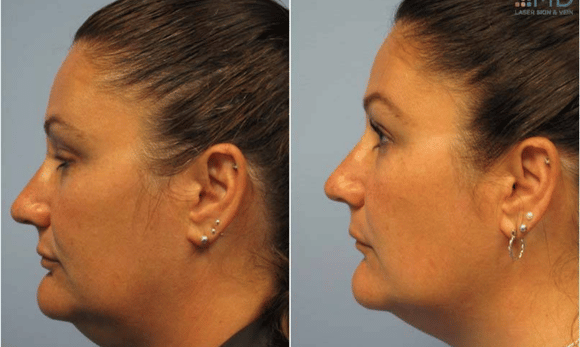 Exilis before and after