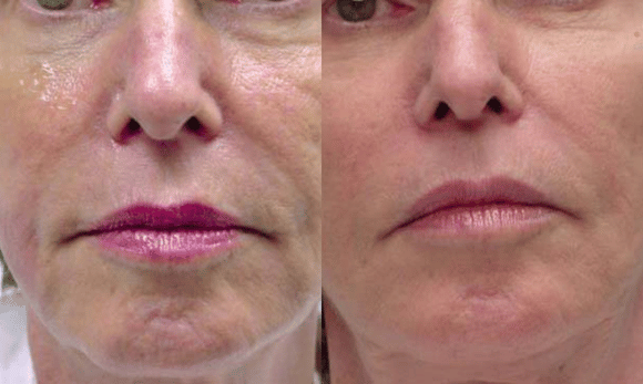 Exilis before and after