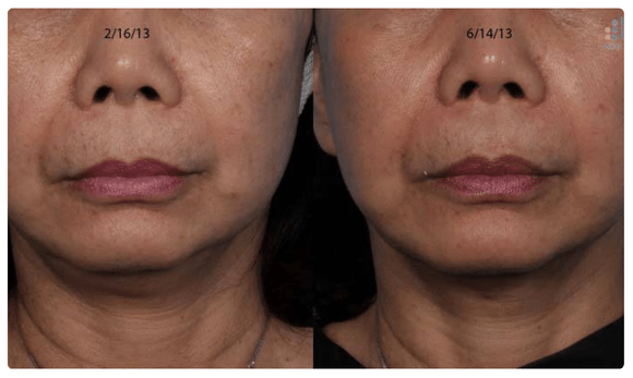 Radiofrequency Microneedling before and after