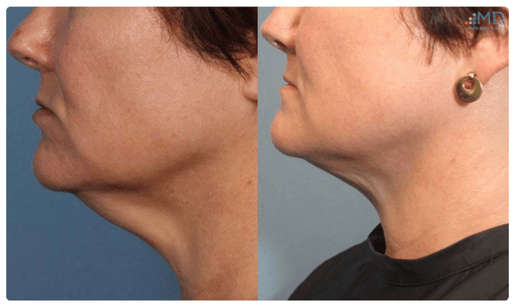 Radiofrequency Microneedling before and after