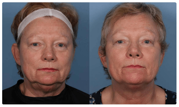 Radiofrequency Microneedling before and after