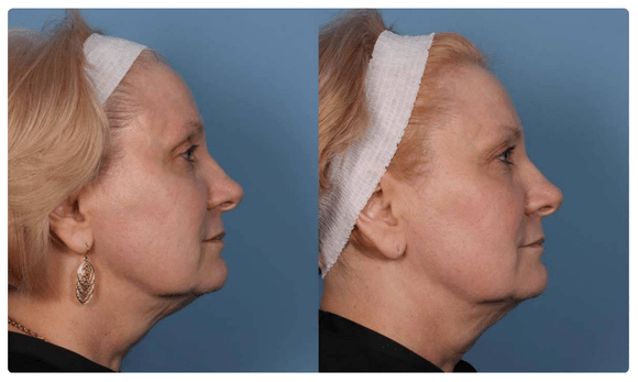 Radiofrequency Microneedling before and after