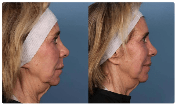 Radiofrequency Microneedling before and after