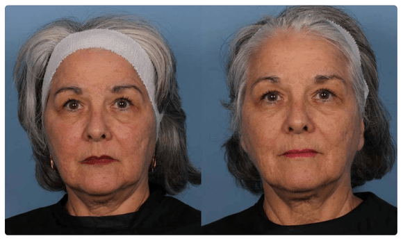 Radiofrequency Microneedling before and after