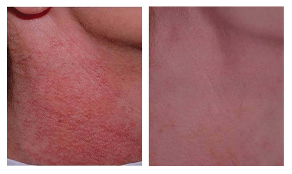 IPL Before and After