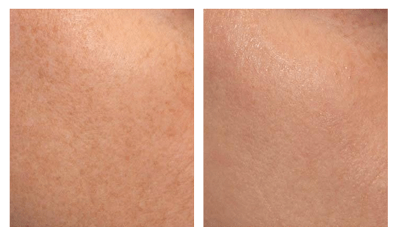 IPL Before and After