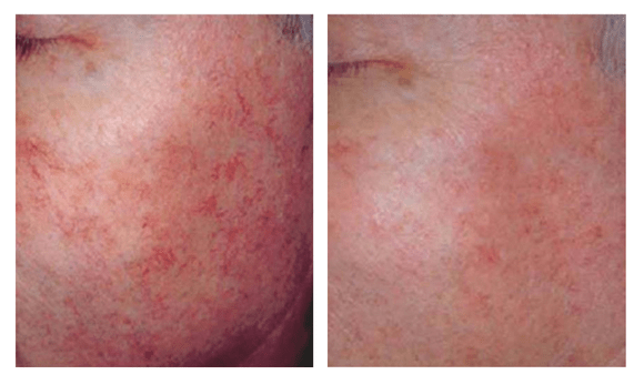 IPL Before and After