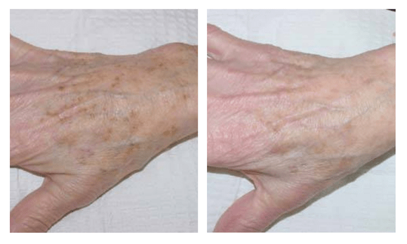 IPL Before and After
