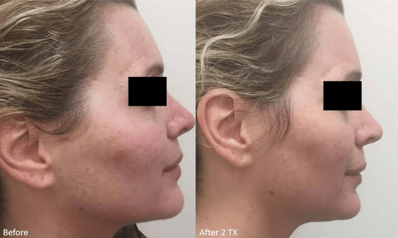 Lutronic LaseMD before and after