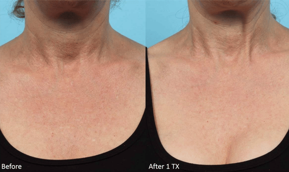Lutronic LaseMD before and after