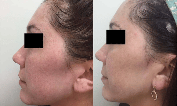 Lutronic LaseMD before and after