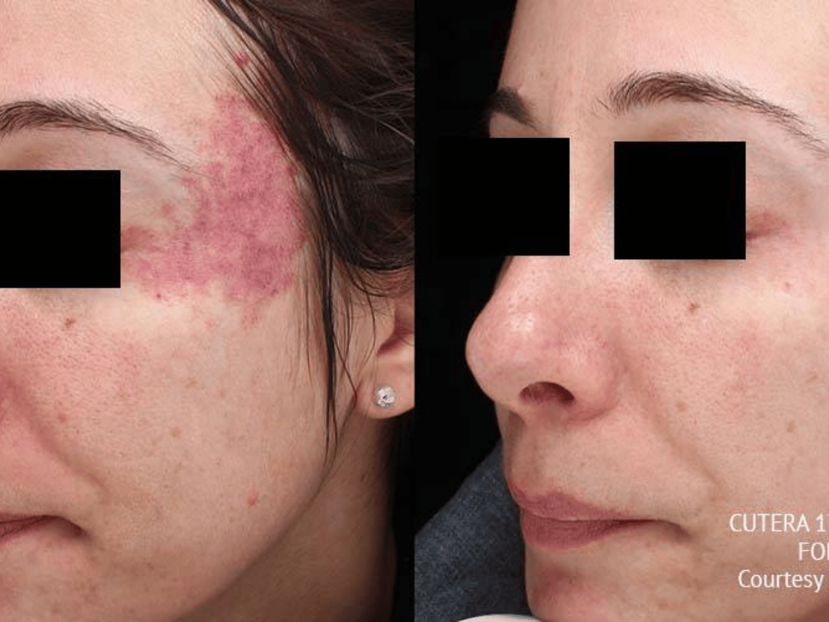 vbeam perfecta before and after