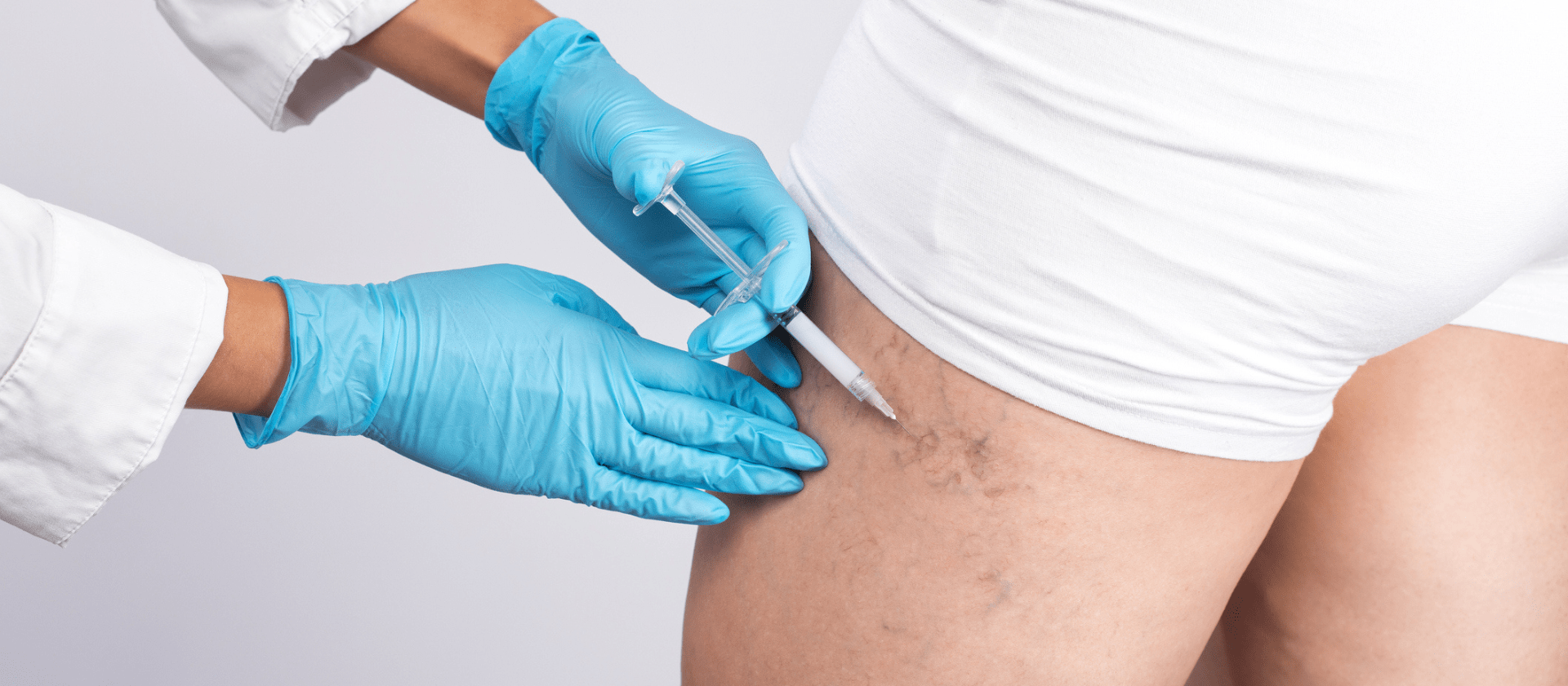 Sclerotherapy treatment in a males legs