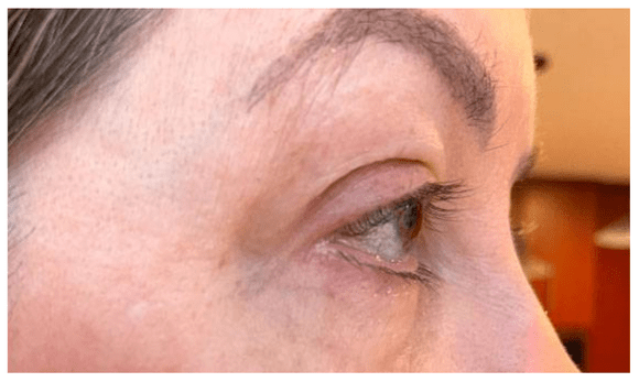 after tixel treatment