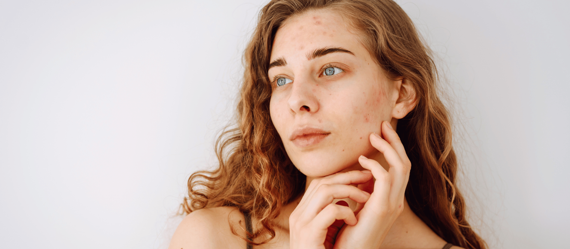 a girl with acne on her cheeks