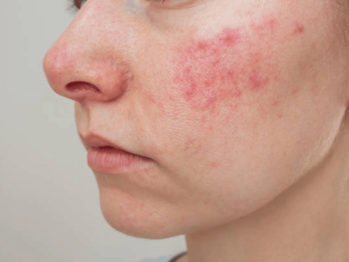 a girl with acne