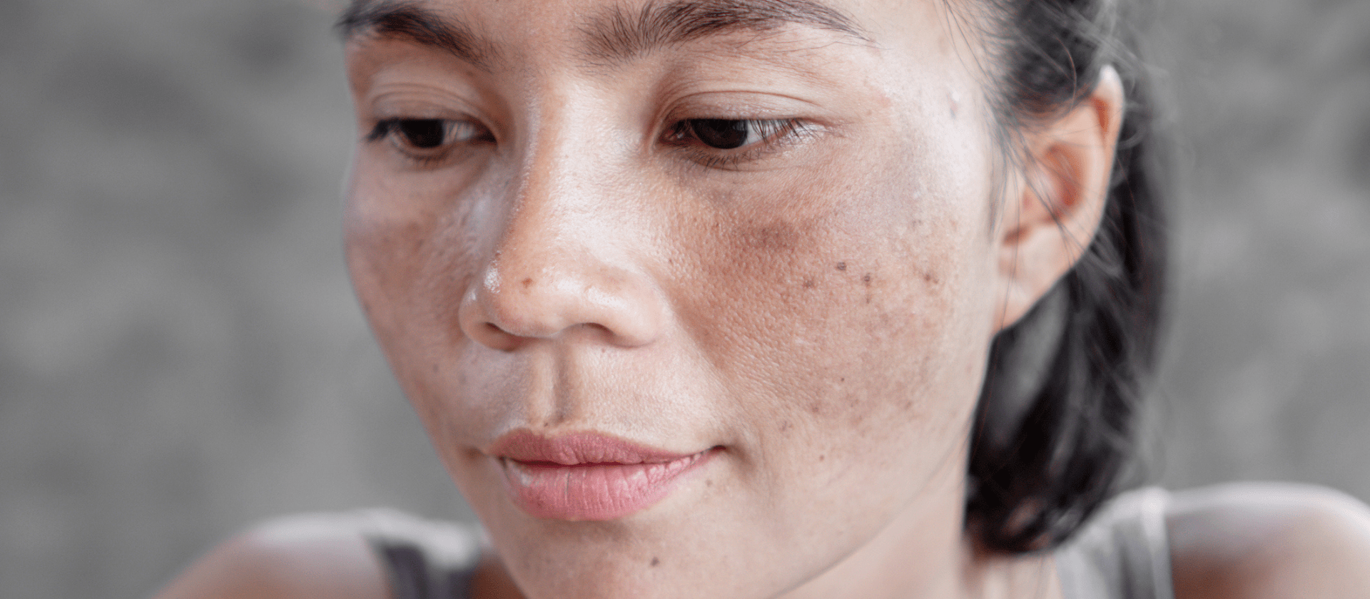 female with sun spots on her cheeks