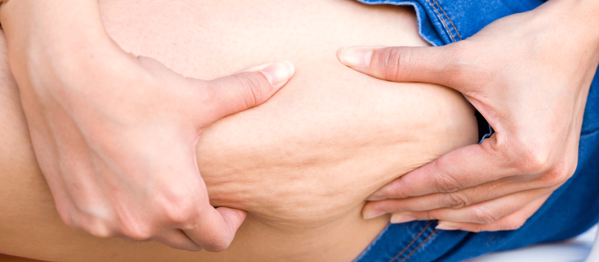 woman pinching cellulite