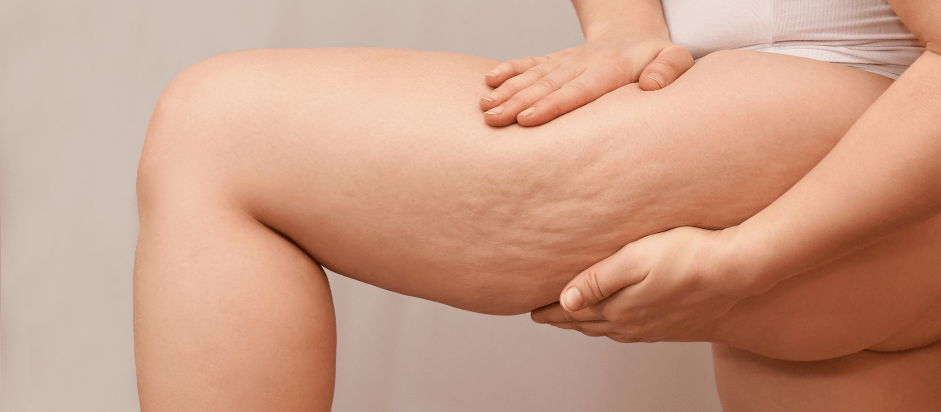 woman showing cellulite on leg
