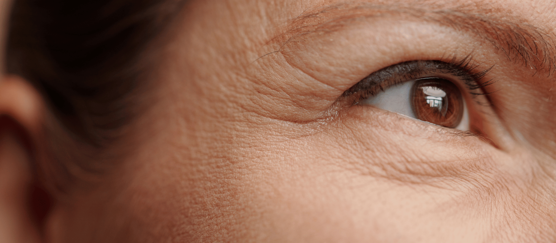 crows feet on outer eyes