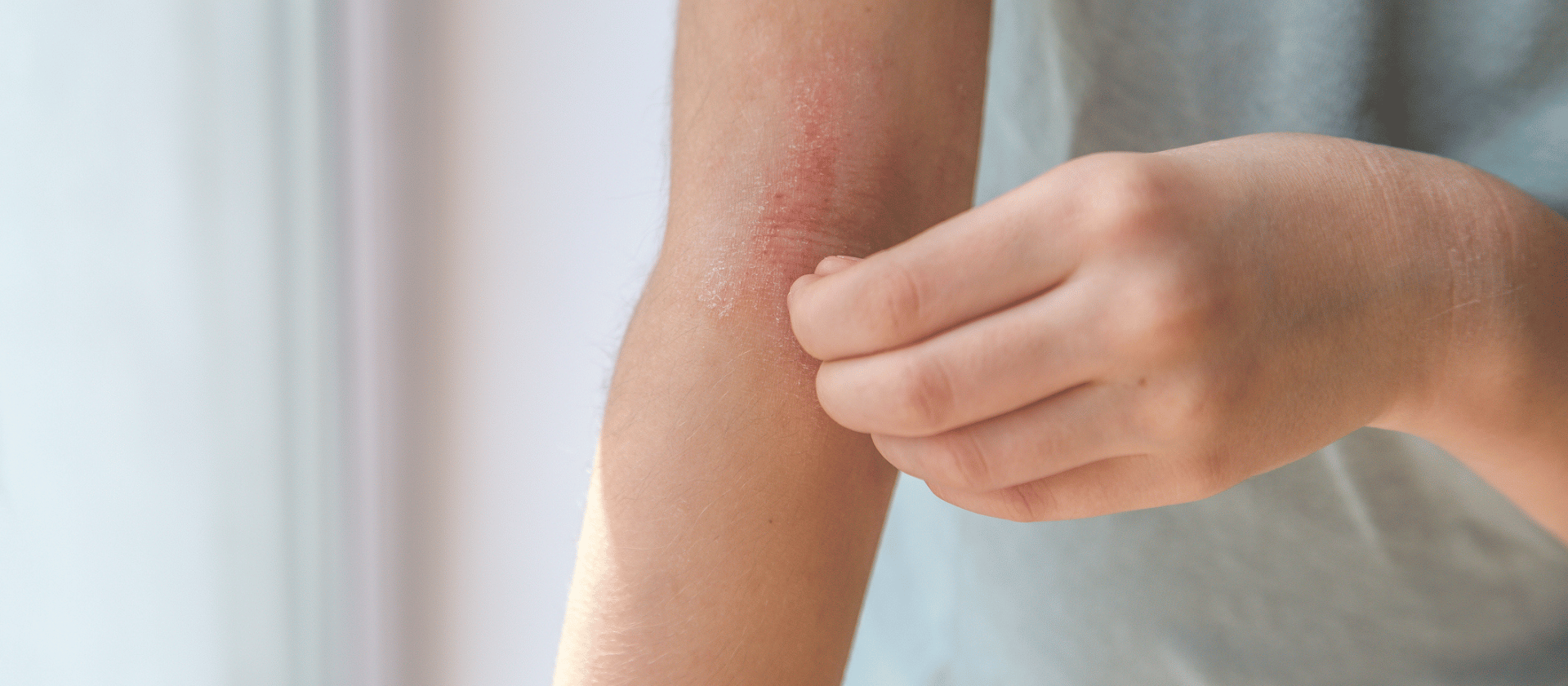 Eczema - Maryland Dermatology Laser, Skin & Vein Institute