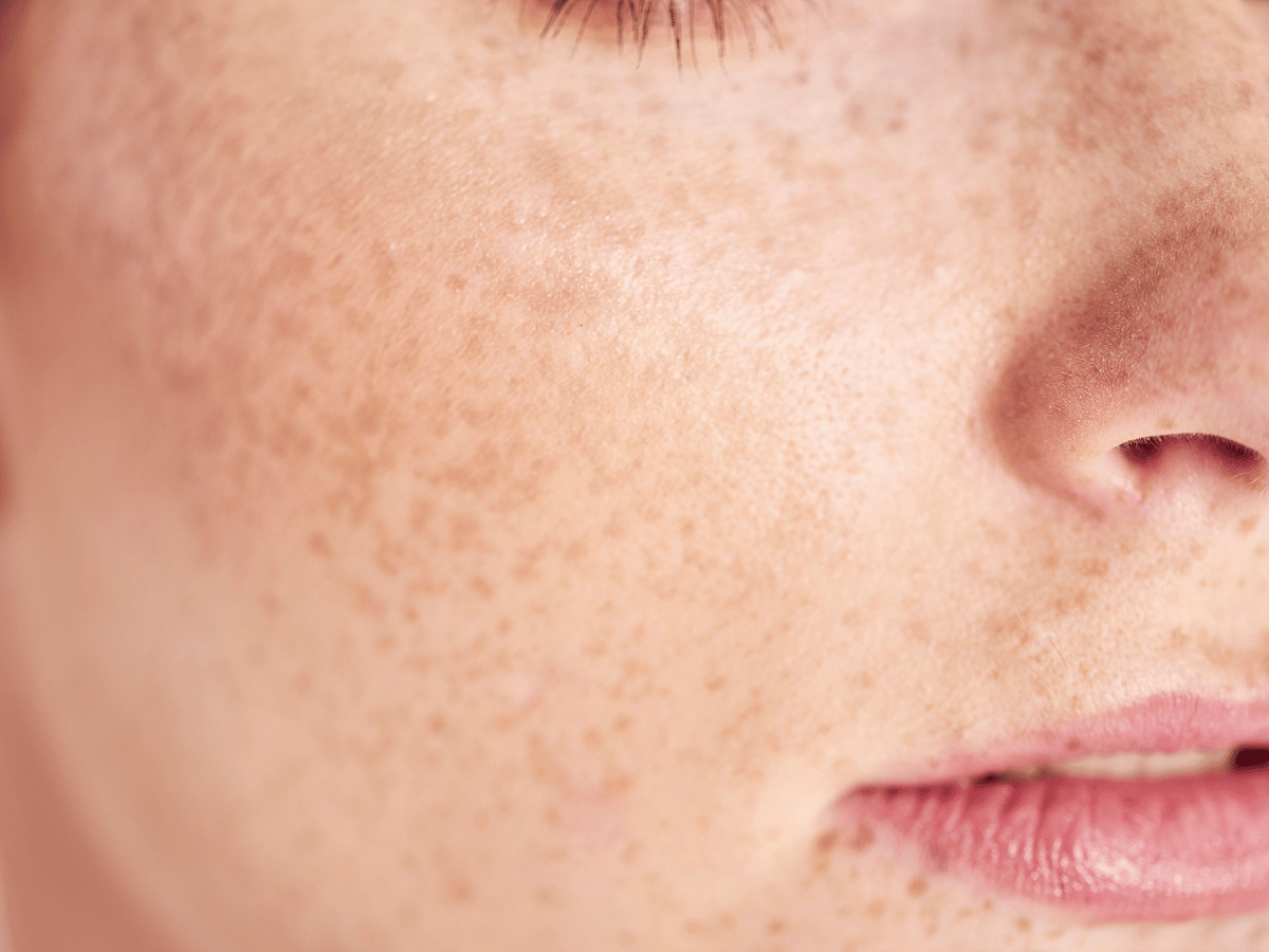 freckles on a girl's face
