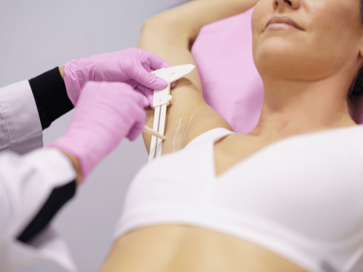 hyperhidrosis treatment