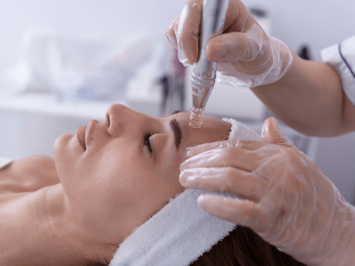 microneedling in forehead