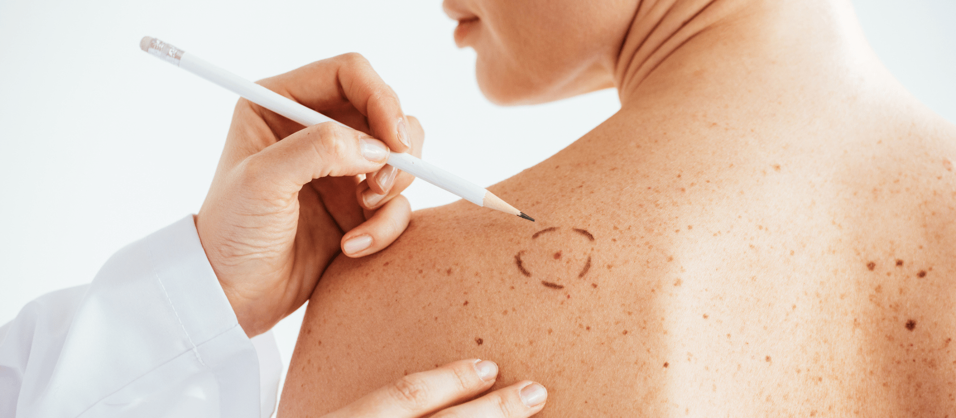 mole mapping on a woman's back