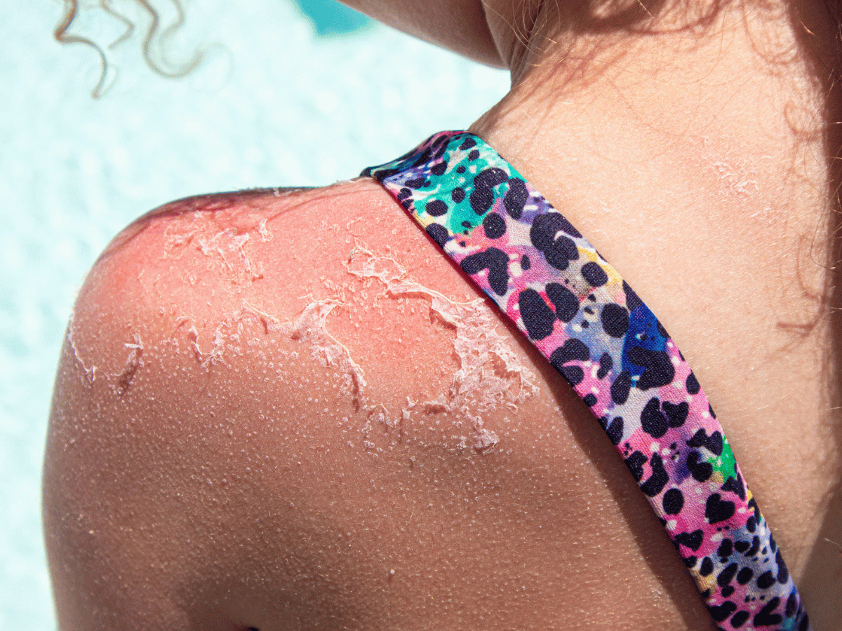back peeling from sunburn