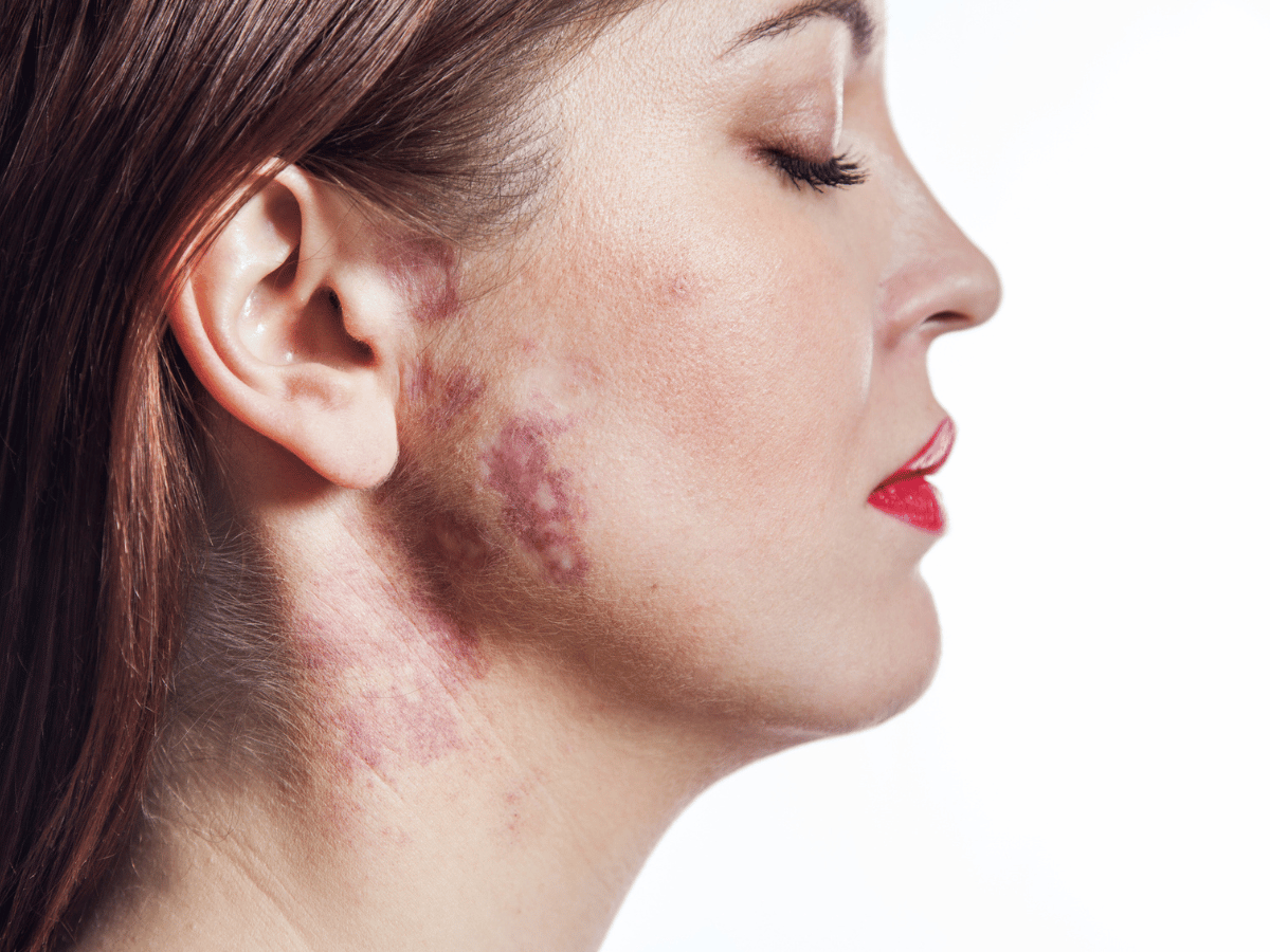 portwine stains on a girl's cheek