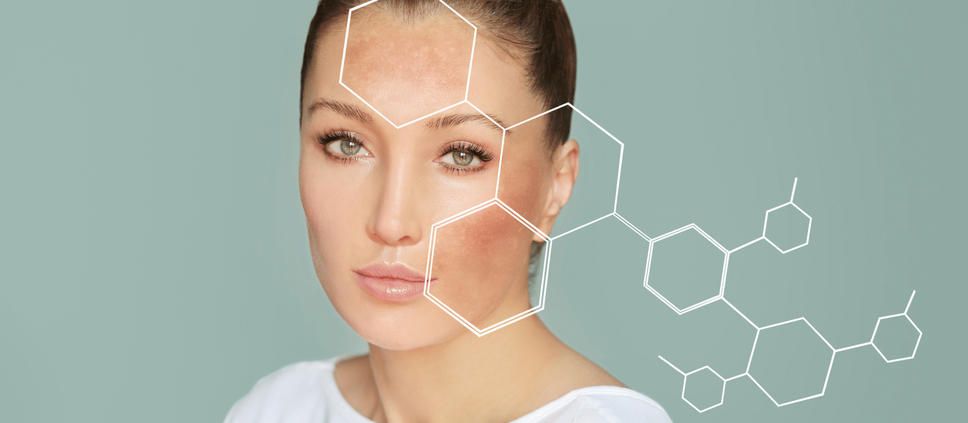 portwine stains on face