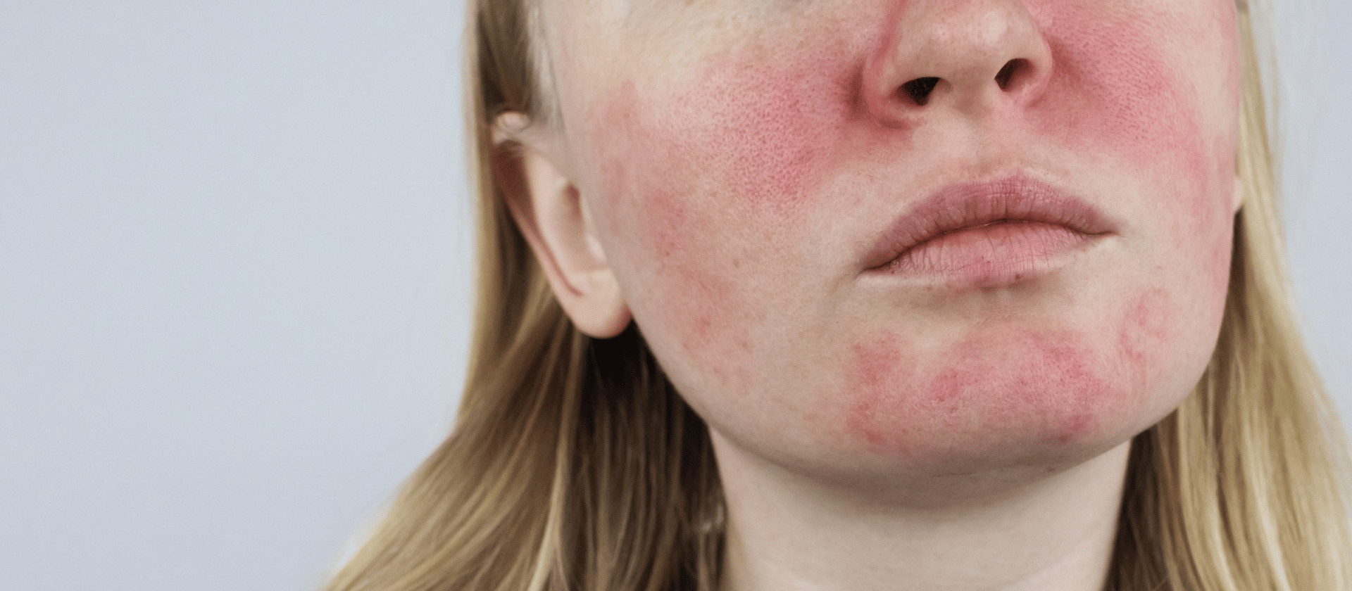 rosacea on face