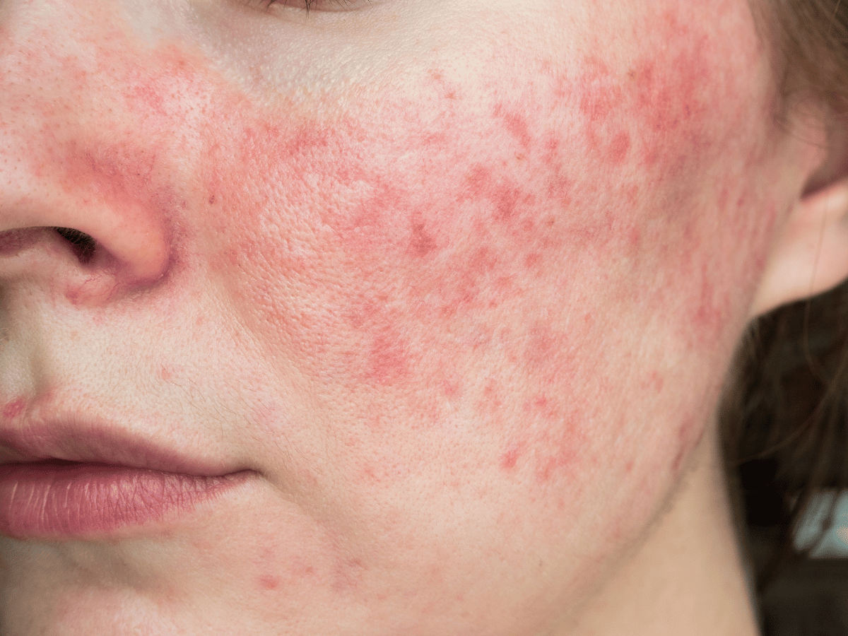 rosacea on cheeks