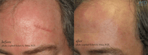 acne scars