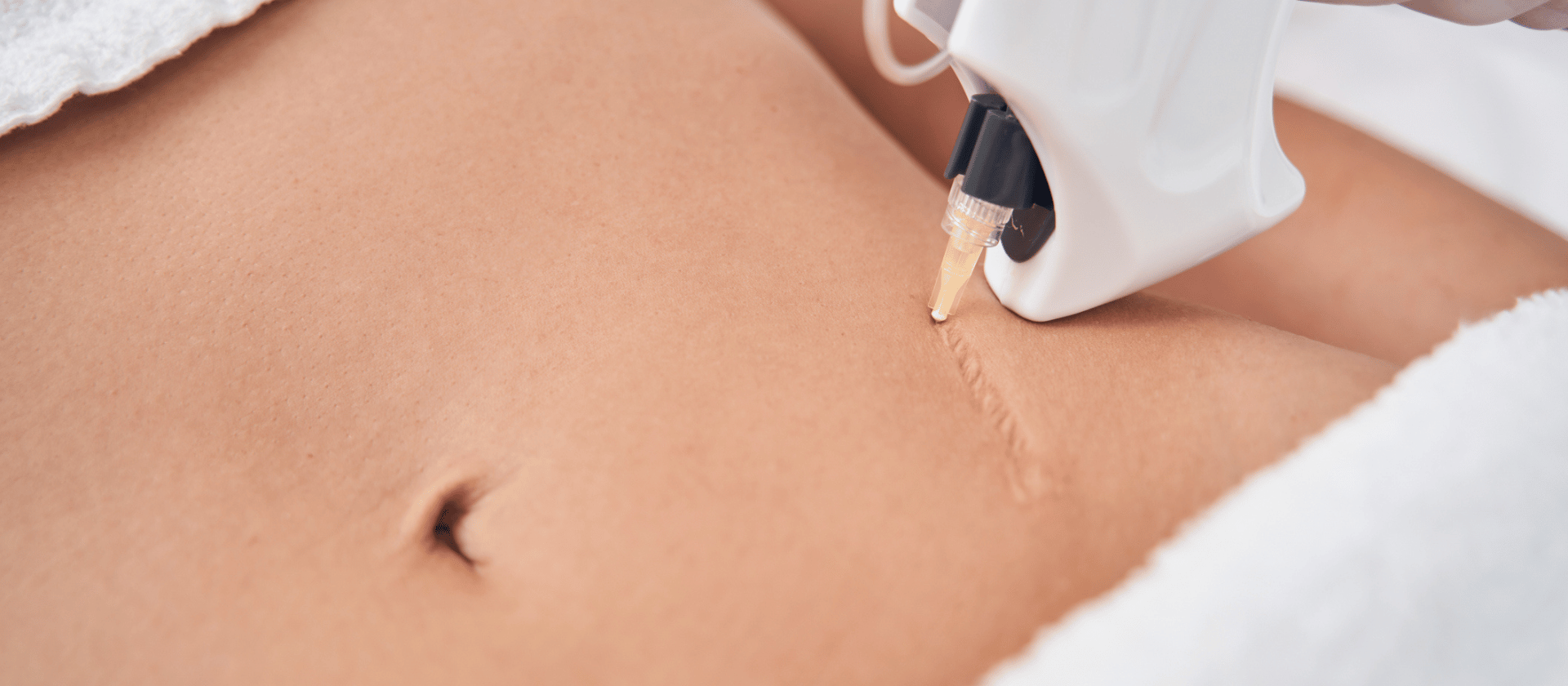 scars on stomach
