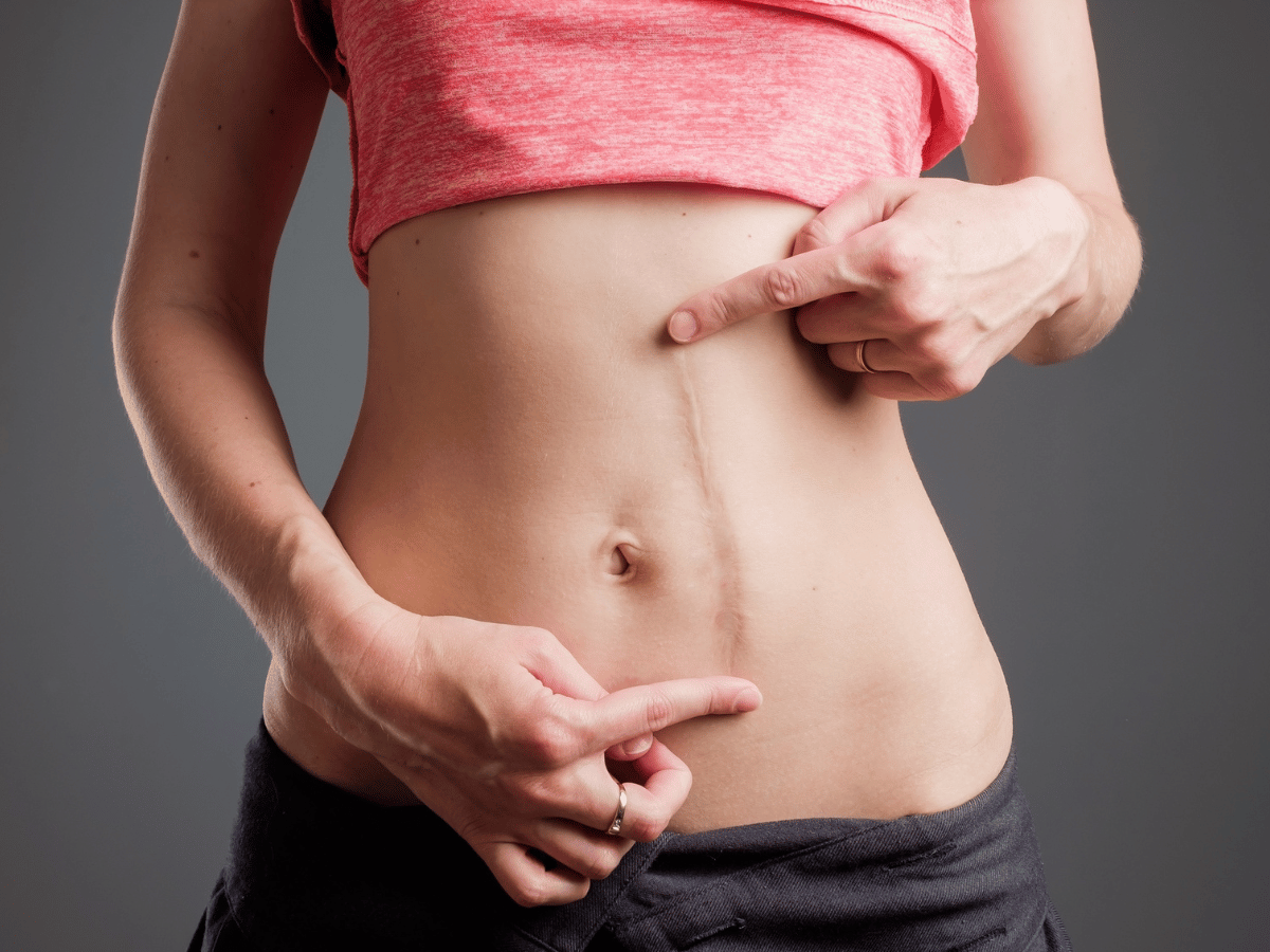 a long scar on a girl's stomach