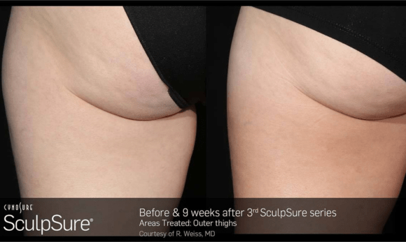 Sculpsure before and after