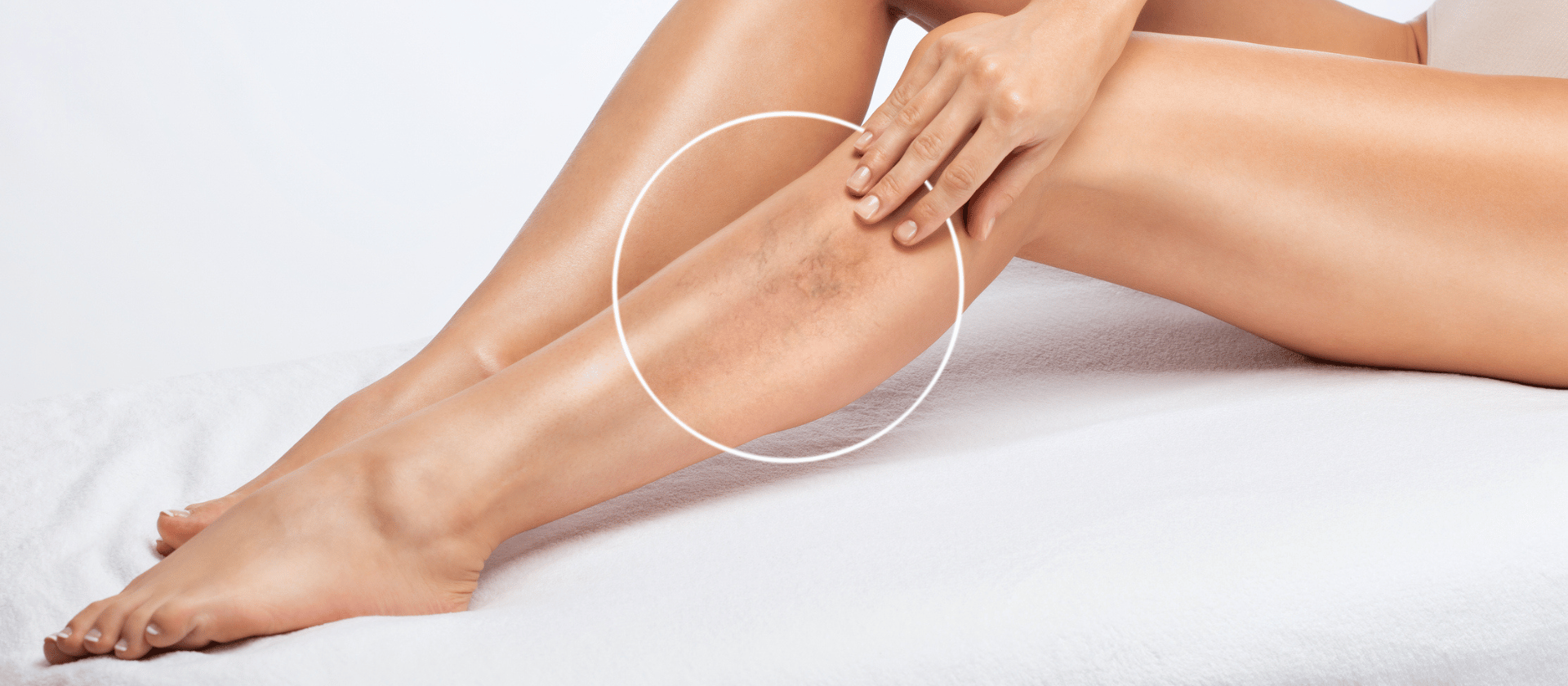 spider veins on leg